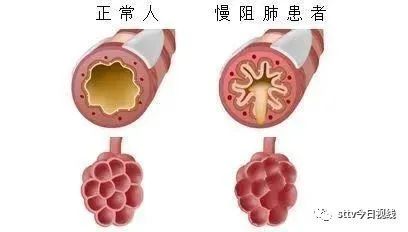 警惕慢阻肺  防控需及早 健康 第2張