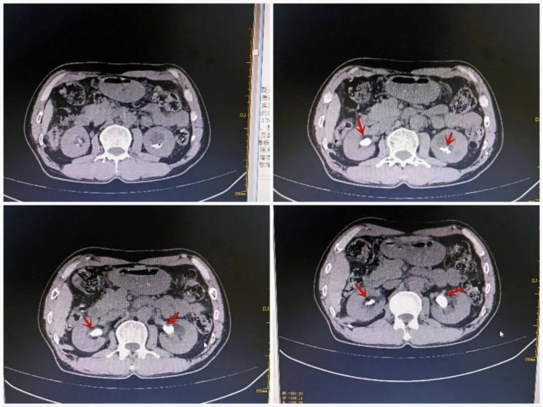 输尿管鞘是什么肾输尿管结石治疗的又一“神器” ——头端可弯曲负压输尿管软镜鞘_https://www.jmylbn.com_新闻资讯_第5张