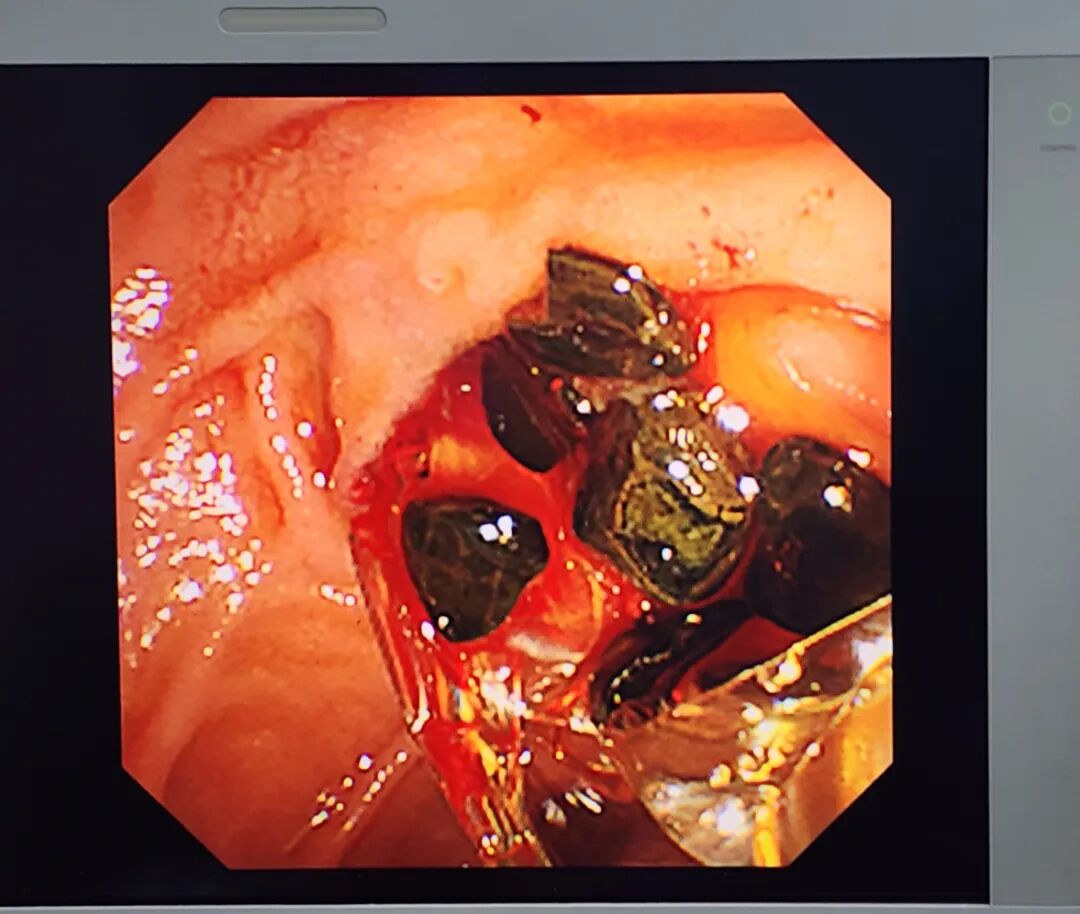取石网篮 为什么贵【创新技术】ERCP+钬激光，联手“口中取石”_https://www.jmylbn.com_新闻资讯_第3张