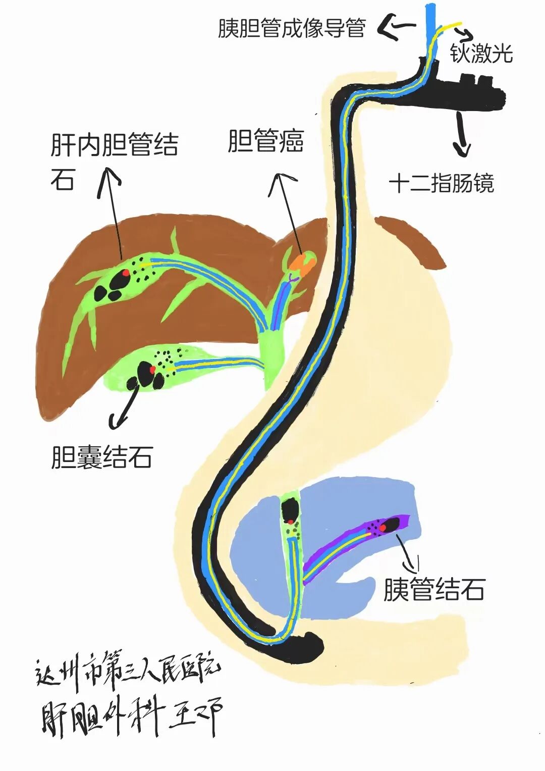 取石网篮 为什么贵【创新技术】ERCP+钬激光，联手“口中取石”_https://www.jmylbn.com_新闻资讯_第5张