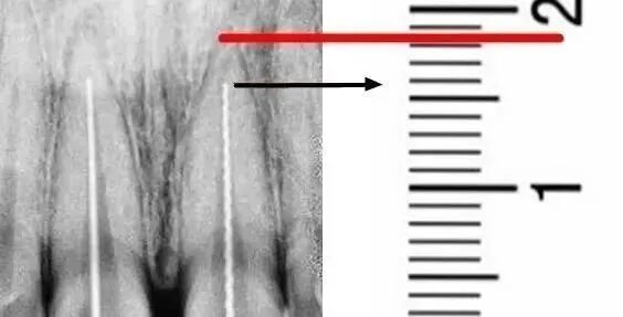 提高根管预备成功率的几个关键点
