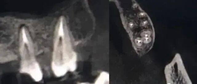 提高根管预备成功率的几个关键点