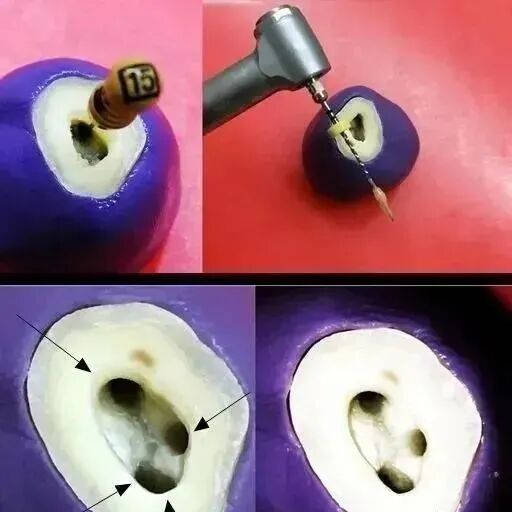 提高根管预备成功率的几个关键点