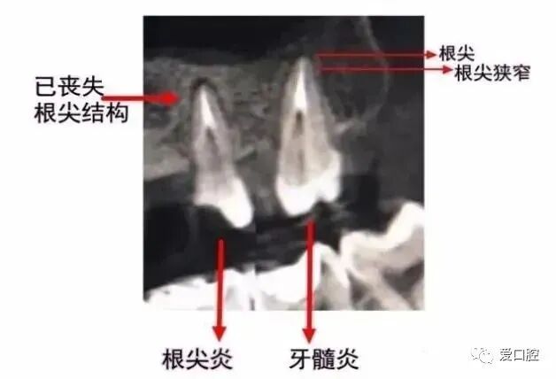 提高根管预备成功率的几个关键点