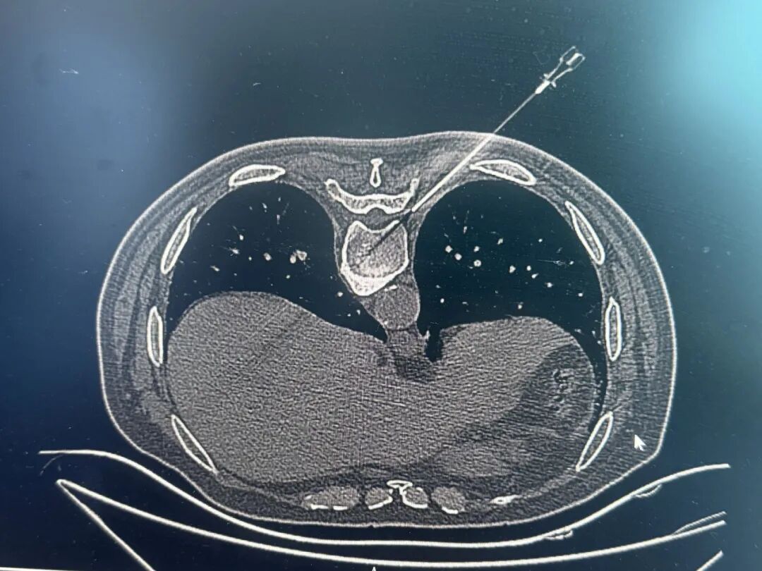 什么叫无影灯【无影灯下】“蛇缠腰”是什么病？你晓得不？_https://www.jmylbn.com_新闻资讯_第7张