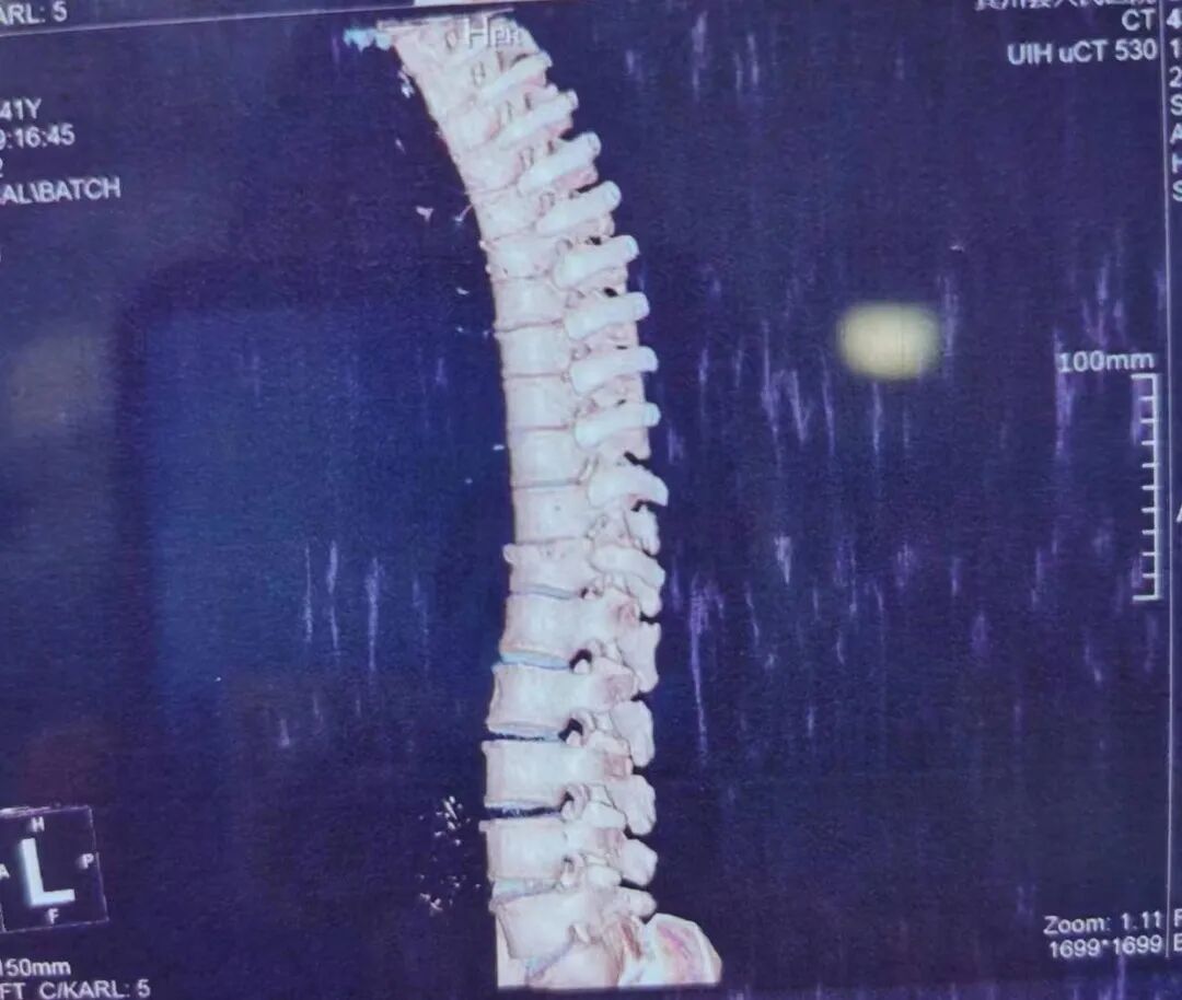 开刀孔怎么开刀胸椎骨折不需开刀，打4个“小孔”解除患者病痛_https://www.jmylbn.com_新闻资讯_第4张