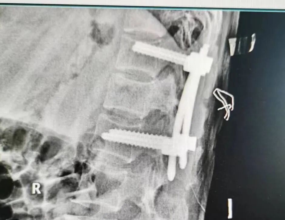 开刀孔怎么开刀胸椎骨折不需开刀，打4个“小孔”解除患者病痛_https://www.jmylbn.com_新闻资讯_第8张