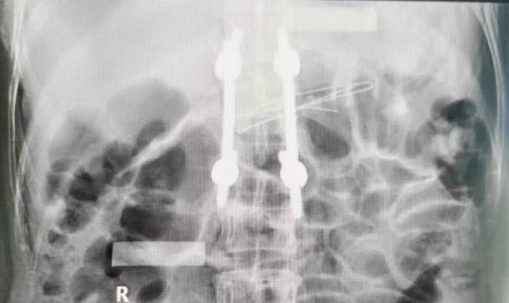 开刀孔怎么开刀胸椎骨折不需开刀，打4个“小孔”解除患者病痛_https://www.jmylbn.com_新闻资讯_第9张