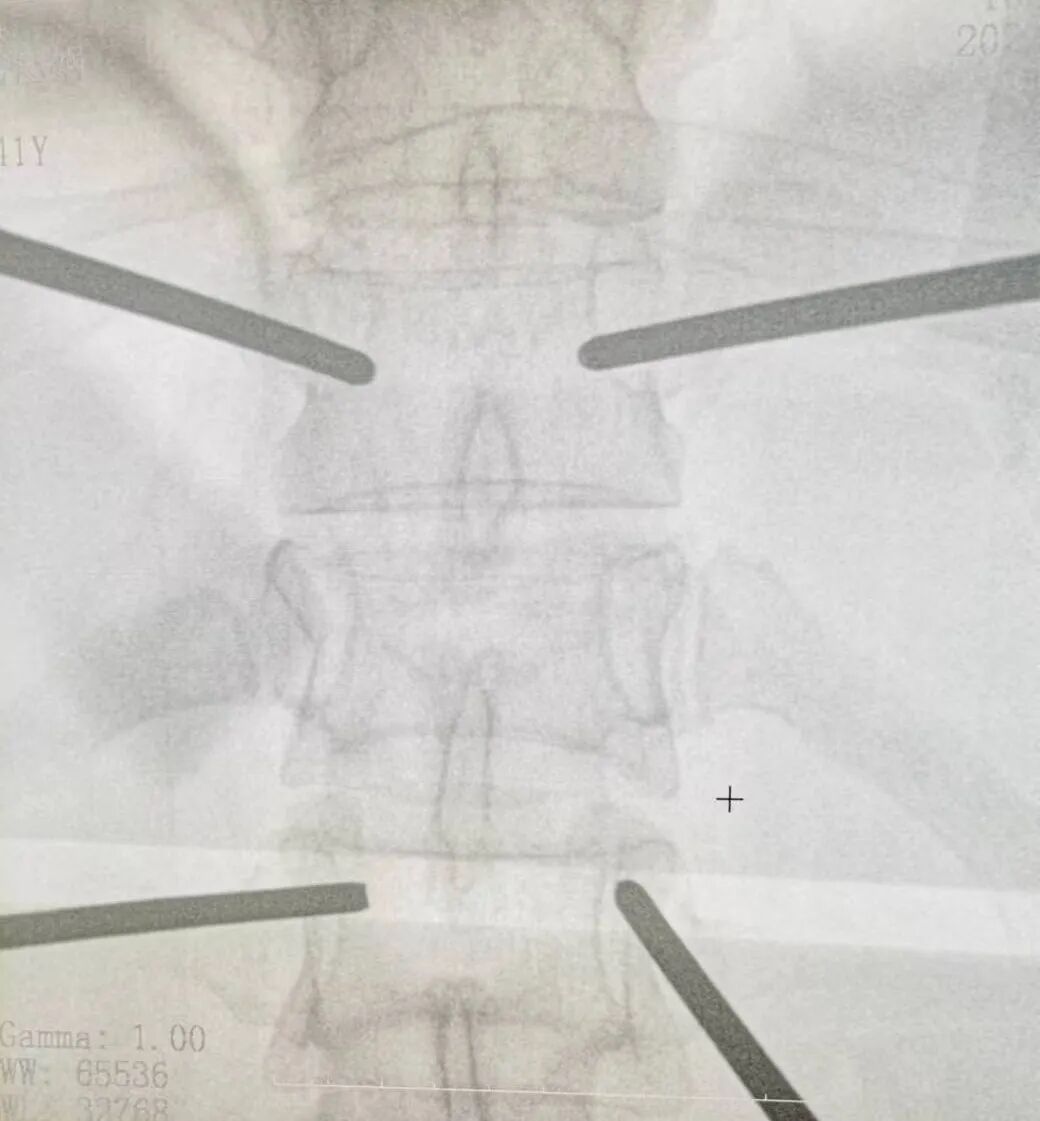 开刀孔怎么开刀胸椎骨折不需开刀，打4个“小孔”解除患者病痛_https://www.jmylbn.com_新闻资讯_第7张