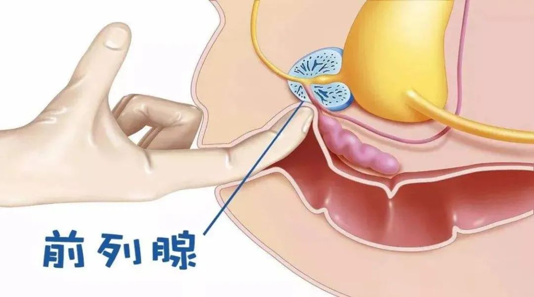 前列無憂指南│前列腺盆腔綜合徵診治最新推薦