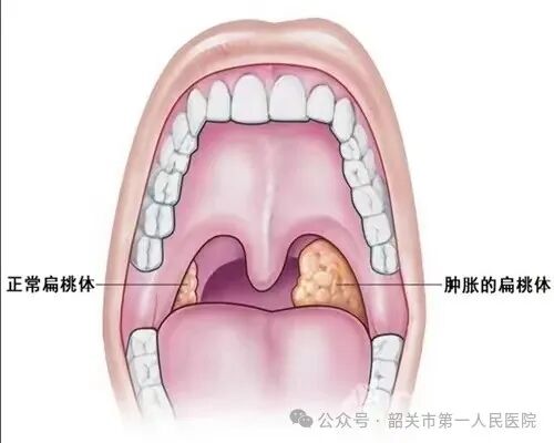 阻塞性睡眠呼吸异常危险因素:扁桃体肥大,下颌后缩(三)体位治疗:侧卧