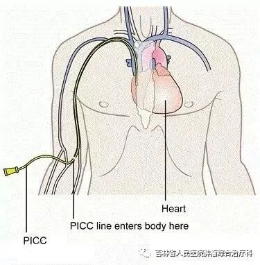 picc导管是什么材质PICC那些事儿_https://www.jmylbn.com_新闻资讯_第3张