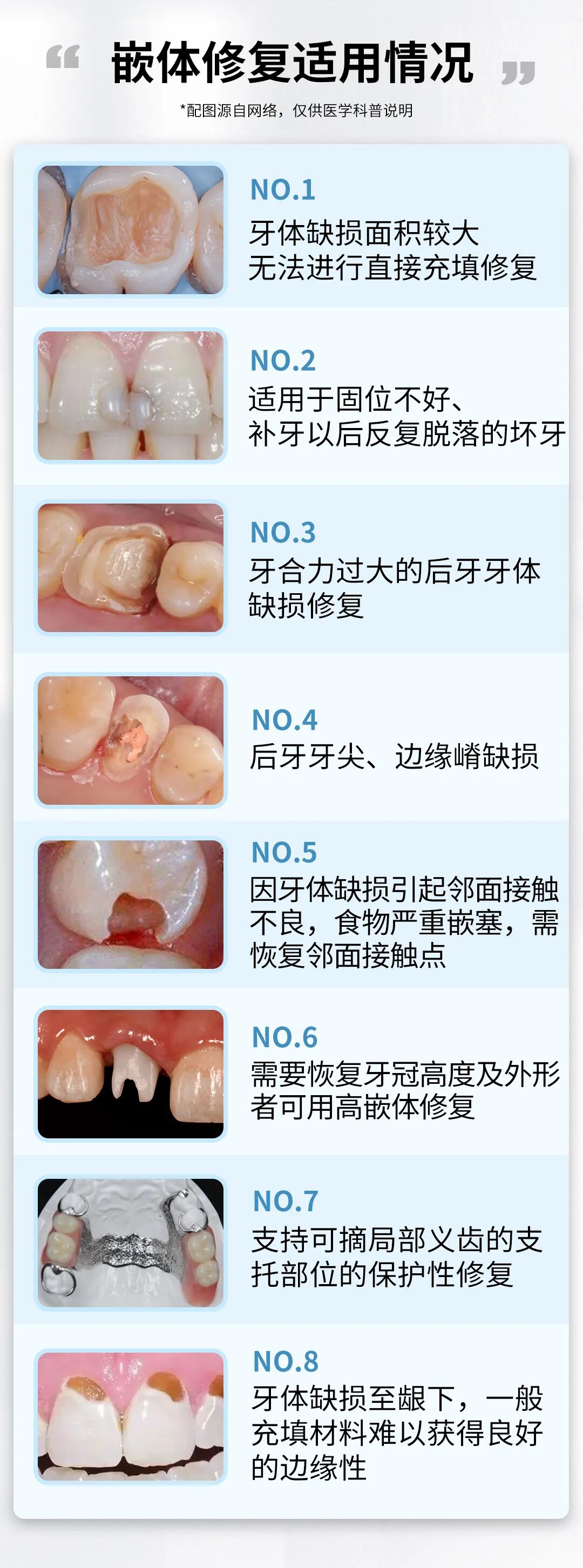 牙科材料硅胶怎么用如果你要做坏牙修复! 牙医告诉你怎么选材料和方案_https://www.jmylbn.com_新闻资讯_第4张