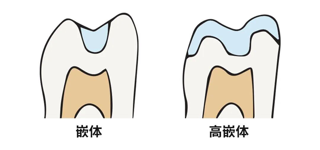 牙科材料硅胶怎么用如果你要做坏牙修复! 牙医告诉你怎么选材料和方案_https://www.jmylbn.com_新闻资讯_第3张