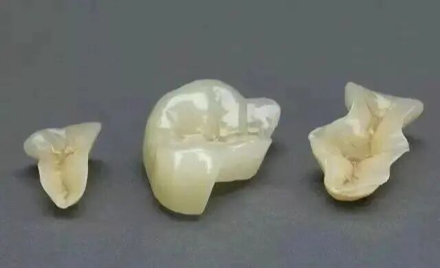 牙科材料硅胶怎么用如果你要做坏牙修复! 牙医告诉你怎么选材料和方案_https://www.jmylbn.com_新闻资讯_第11张