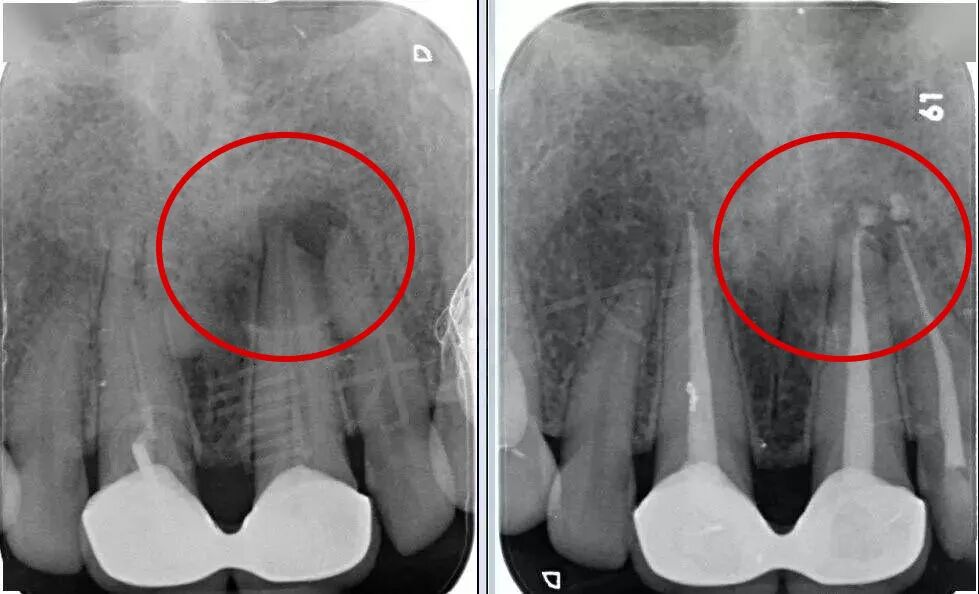 X光拍片为什么要等看牙为什么要拍片？非专业人士如何看懂自己的牙片！_https://www.jmylbn.com_新闻资讯_第10张