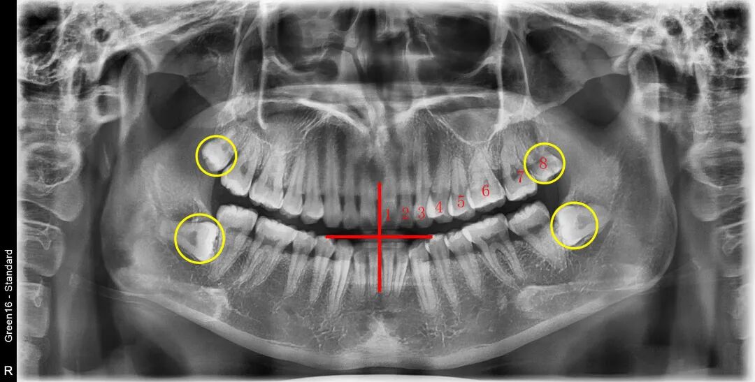 X光拍片为什么要等看牙为什么要拍片？非专业人士如何看懂自己的牙片！_https://www.jmylbn.com_新闻资讯_第8张