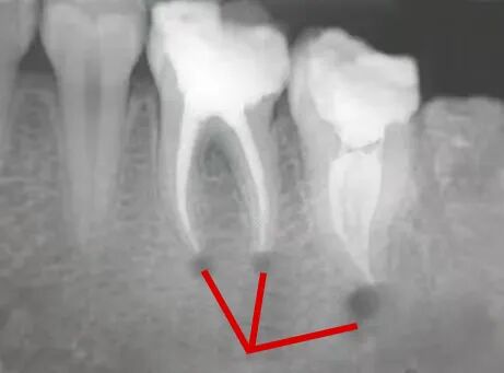 X光拍片为什么要等看牙为什么要拍片？非专业人士如何看懂自己的牙片！_https://www.jmylbn.com_新闻资讯_第16张