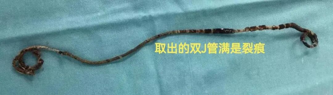 输尿管导管是什么小支架，大作用——泌尿系结石术后留置双J管患者出院指导_https://www.jmylbn.com_新闻资讯_第7张