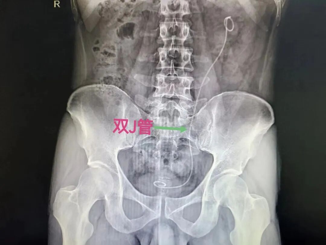 输尿管导管是什么小支架，大作用——泌尿系结石术后留置双J管患者出院指导_https://www.jmylbn.com_新闻资讯_第3张