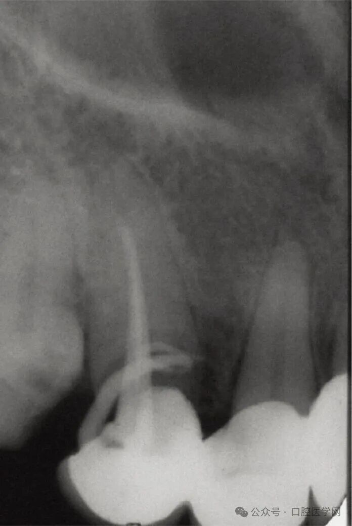 没拆冠，充完麻了，一例根管治疗引发的罕见病例