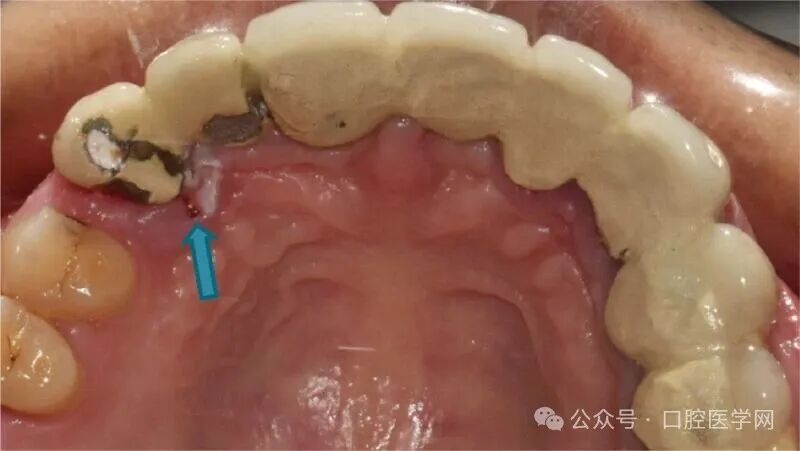 没拆冠，充完麻了，一例根管治疗引发的罕见病例