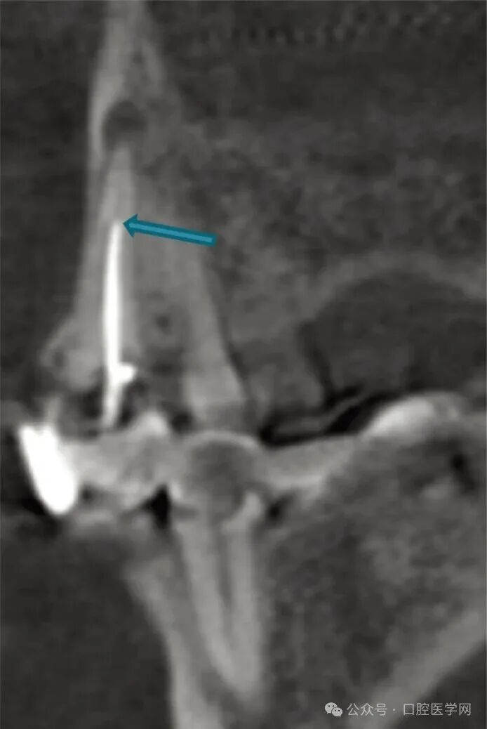没拆冠，充完麻了，一例根管治疗引发的罕见病例