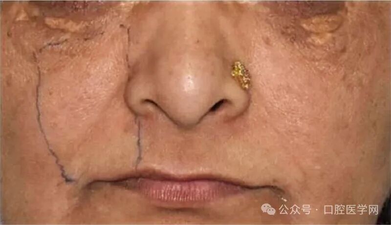 没拆冠，充完麻了，一例根管治疗引发的罕见病例