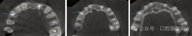 没拆冠，充完麻了，一例根管治疗引发的罕见病例