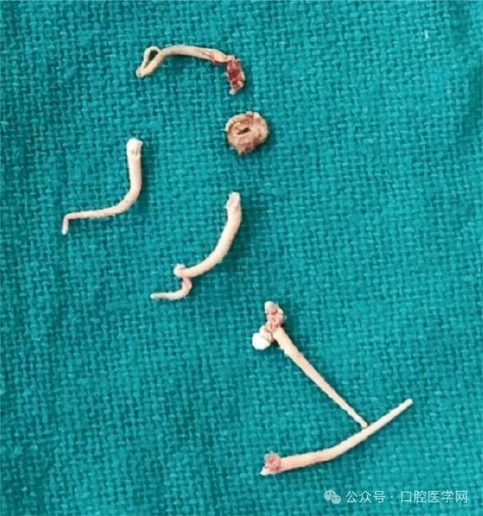 没拆冠，充完麻了，一例根管治疗引发的罕见病例