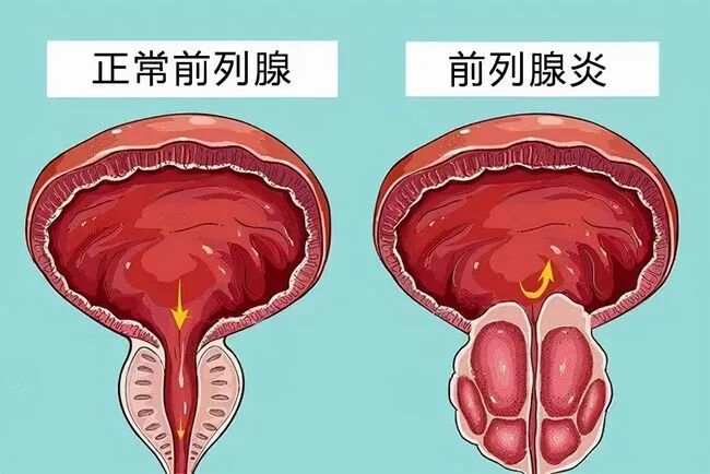 医用蓝光是治什么【益·健康】朱平教授：著书讲解红蓝光疗法照射治疗前列腺炎、前列腺增生、前列腺肥大，效果显著-上海聚慕医疗器械有限公司