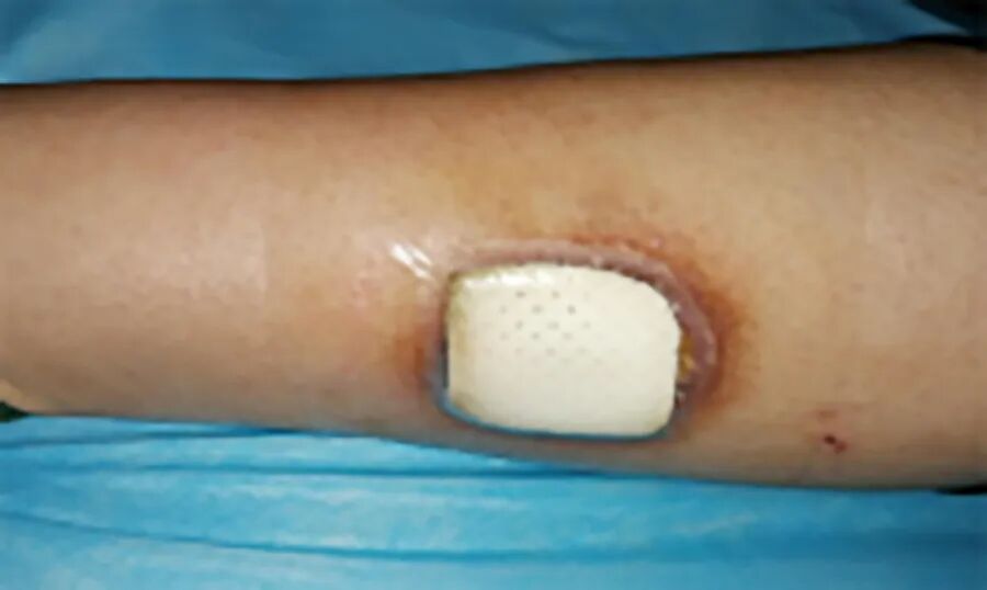 创面修复抗菌敷料怎么用【开诊啦】包头市第四医院（包头市儿童医院）创面修复与烧伤门诊开诊_https://www.jmylbn.com_新闻资讯_第2张