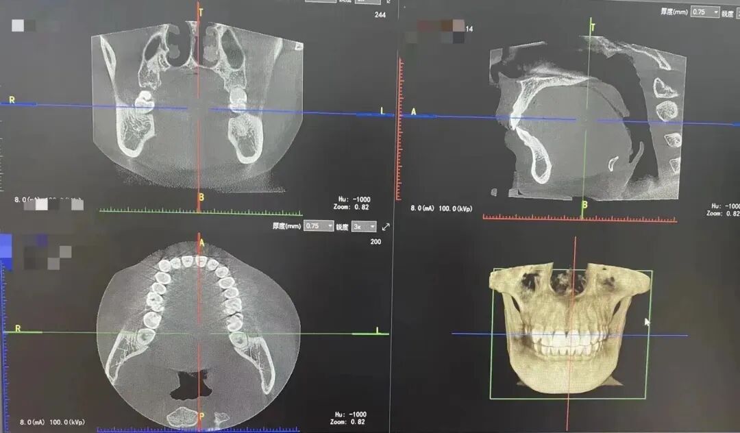 口腔ct怎么拍摄【专科天地】没有口腔CT，你根本不会想到自己的牙齿长得多“奇葩”！_https://www.jmylbn.com_新闻资讯_第12张