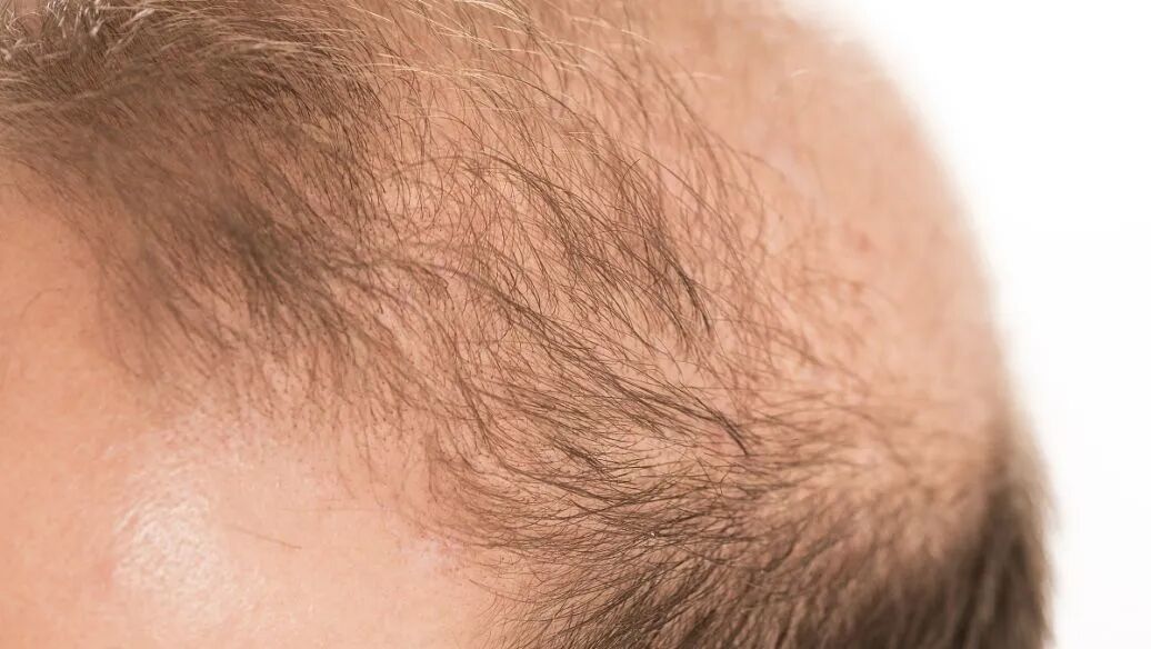 最常见的脱发类型——雄激素性脱发（脂溢性脱发）
