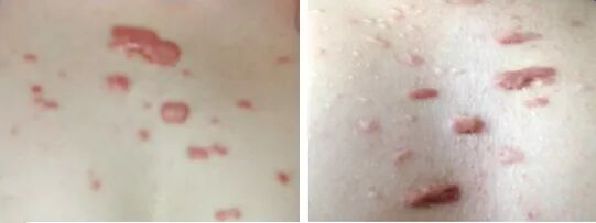 警惕！毛囊炎可能变成瘢痕疙瘩