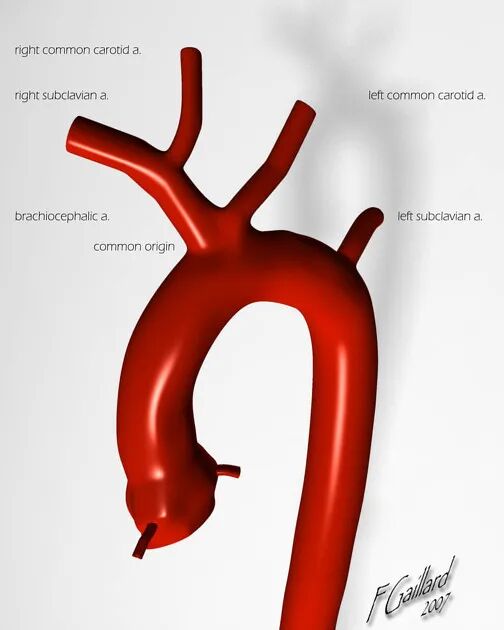 什么叫做交换导丝牛型主动脉弓（bovine aortic arch）-上海聚慕医疗器械有限公司