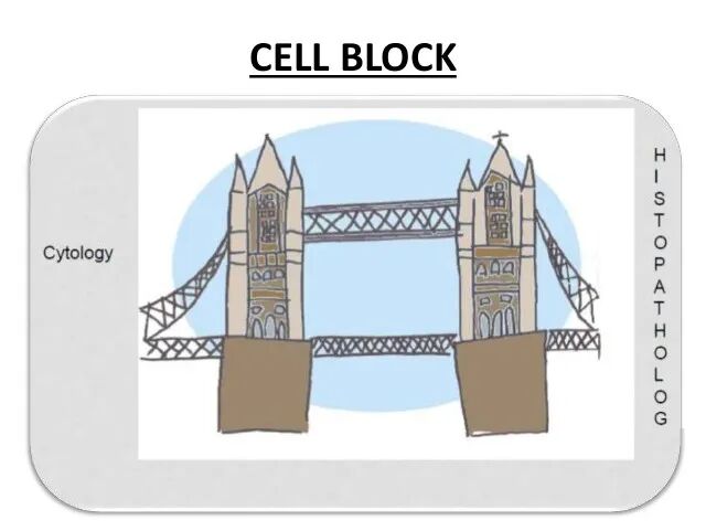 什么是病理蜡块【病理技术分享】精确诊断添利器胸腹水细胞蜡块_https://www.jmylbn.com_新闻资讯_第3张