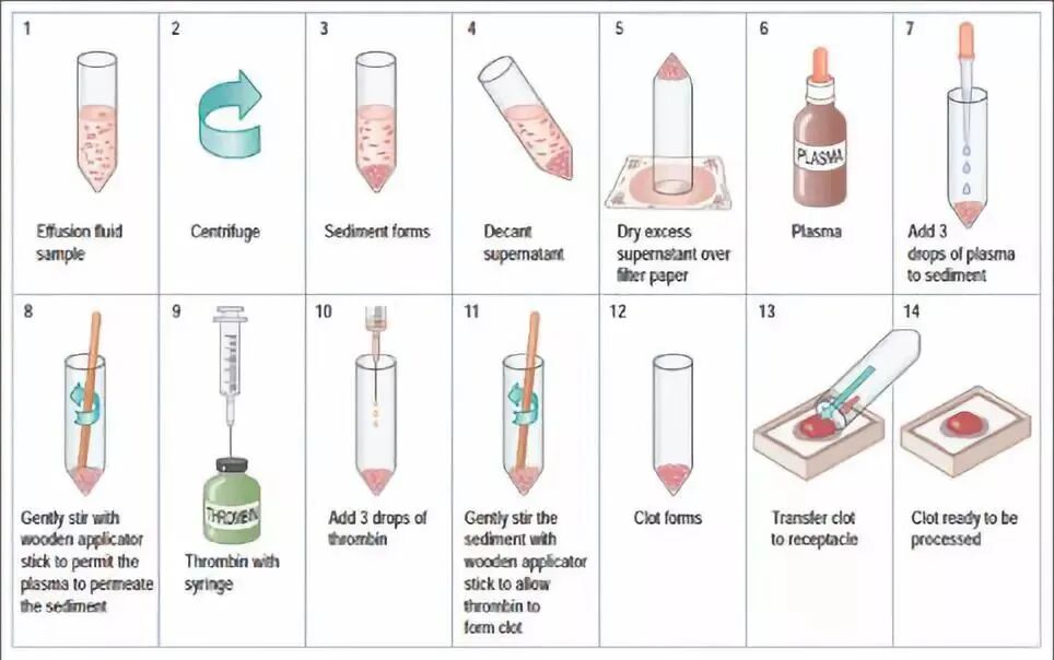 什么是病理蜡块【病理技术分享】精确诊断添利器胸腹水细胞蜡块_https://www.jmylbn.com_新闻资讯_第7张