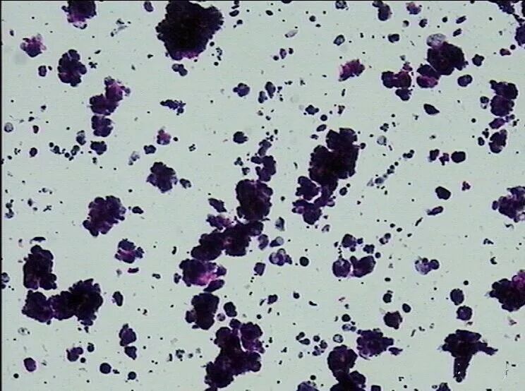 什么是病理蜡块【病理技术分享】精确诊断添利器胸腹水细胞蜡块_https://www.jmylbn.com_新闻资讯_第16张