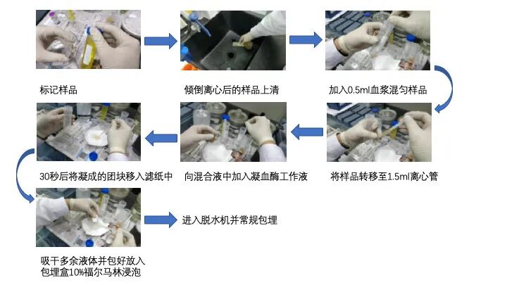 什么是病理蜡块【病理技术分享】精确诊断添利器胸腹水细胞蜡块_https://www.jmylbn.com_新闻资讯_第8张