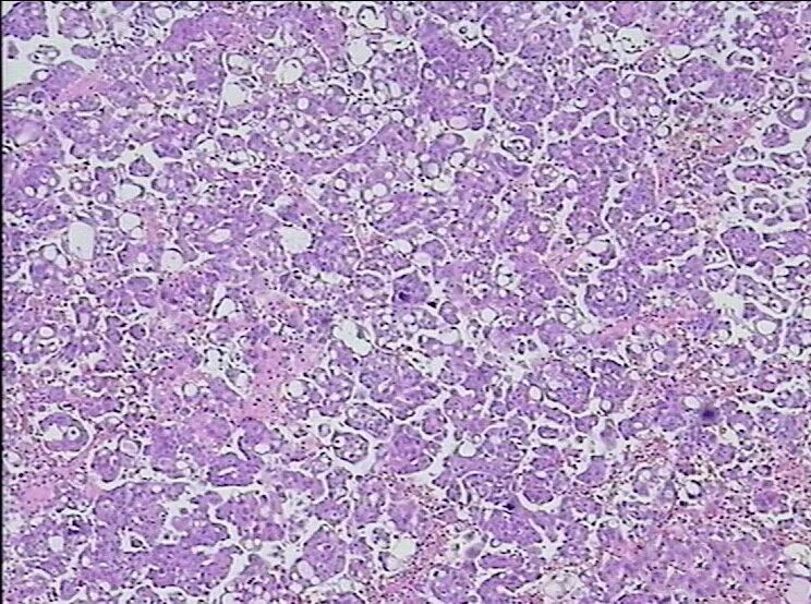 什么是病理蜡块【病理技术分享】精确诊断添利器胸腹水细胞蜡块_https://www.jmylbn.com_新闻资讯_第17张