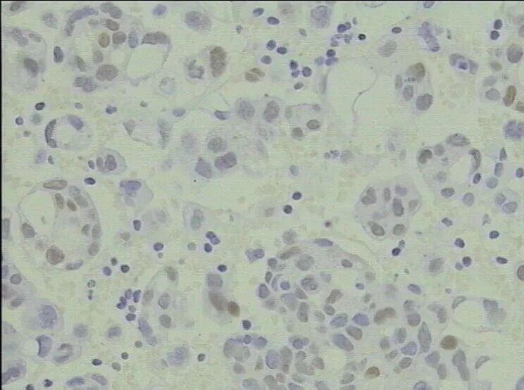 什么是病理蜡块【病理技术分享】精确诊断添利器胸腹水细胞蜡块_https://www.jmylbn.com_新闻资讯_第18张