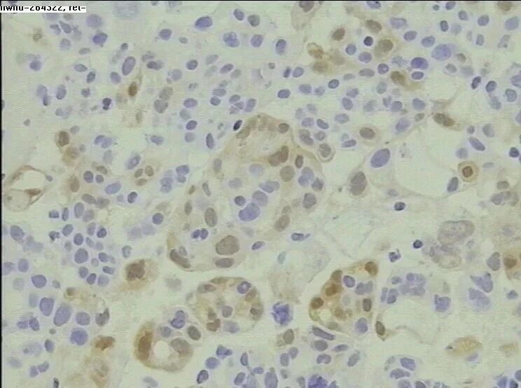 什么是病理蜡块【病理技术分享】精确诊断添利器胸腹水细胞蜡块_https://www.jmylbn.com_新闻资讯_第19张