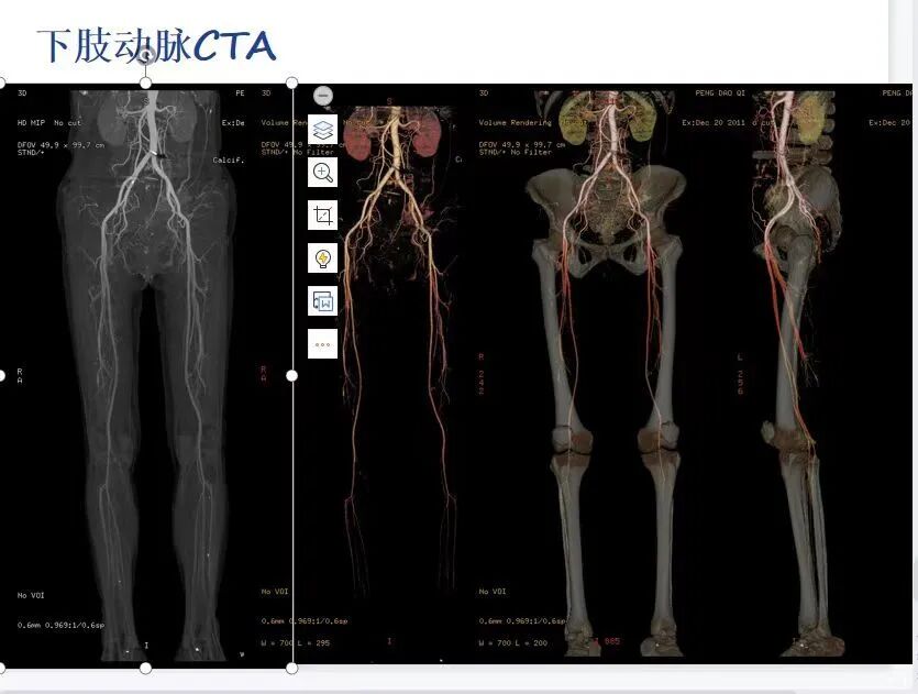 ge ct机为什么要供我院最新引进＂CT界航母＂—GE256排512层Revolution CT机_https://www.jmylbn.com_新闻资讯_第9张