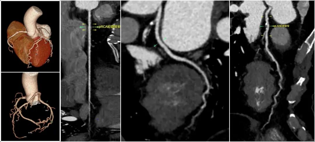 ge ct机为什么要供我院最新引进＂CT界航母＂—GE256排512层Revolution CT机_https://www.jmylbn.com_新闻资讯_第7张