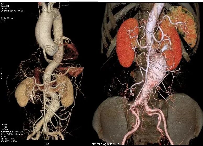 ge ct机为什么要供我院最新引进＂CT界航母＂—GE256排512层Revolution CT机_https://www.jmylbn.com_新闻资讯_第5张
