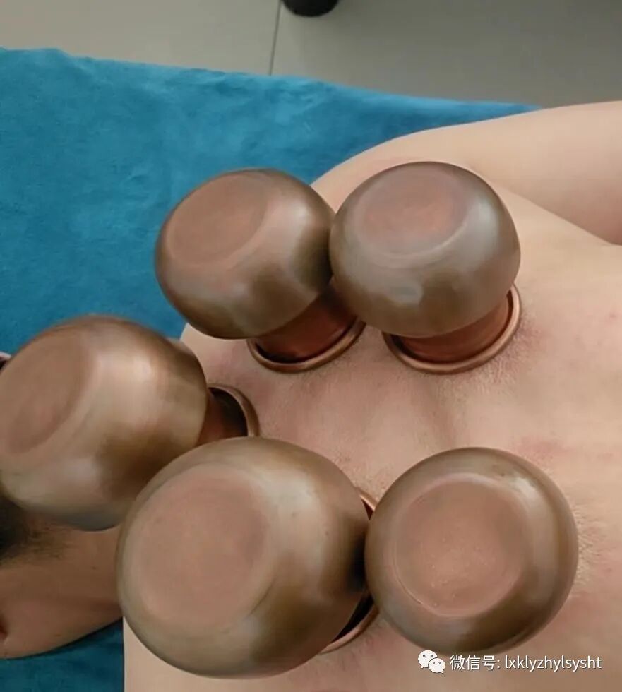 竹火罐怎么用中医绿色疗法       铜火罐中医传统三大疗法之一 火罐疗法（竹罐，铜罐，砭石罐等）_https://www.jmylbn.com_新闻资讯_第3张