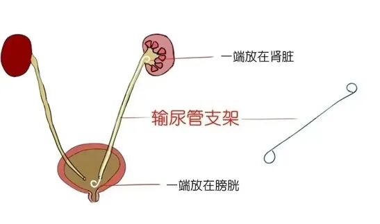 输尿管导管是什么【健康科普】什么是双J管_https://www.jmylbn.com_新闻资讯_第2张