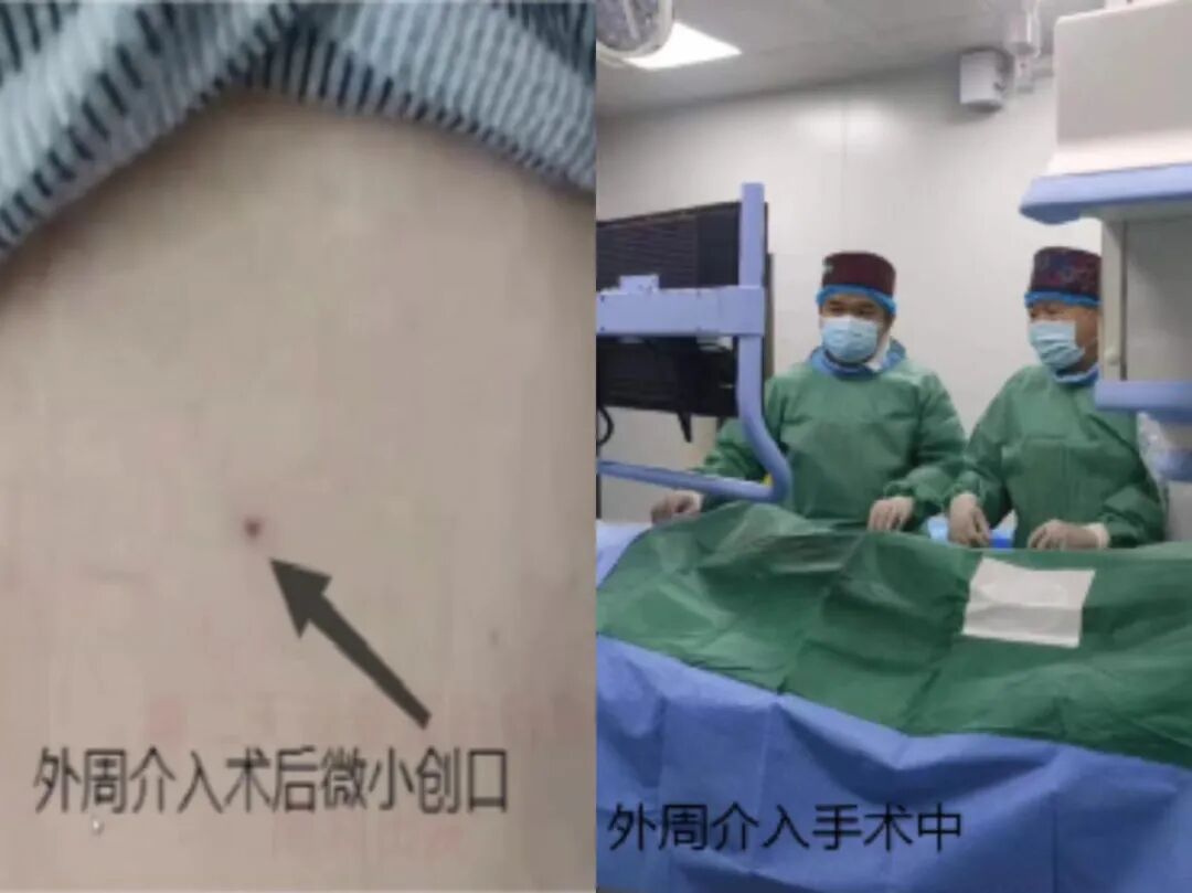 什么是外周介入【新技术】外周疾病找介入   微创高效多优处_https://www.jmylbn.com_新闻资讯_第2张