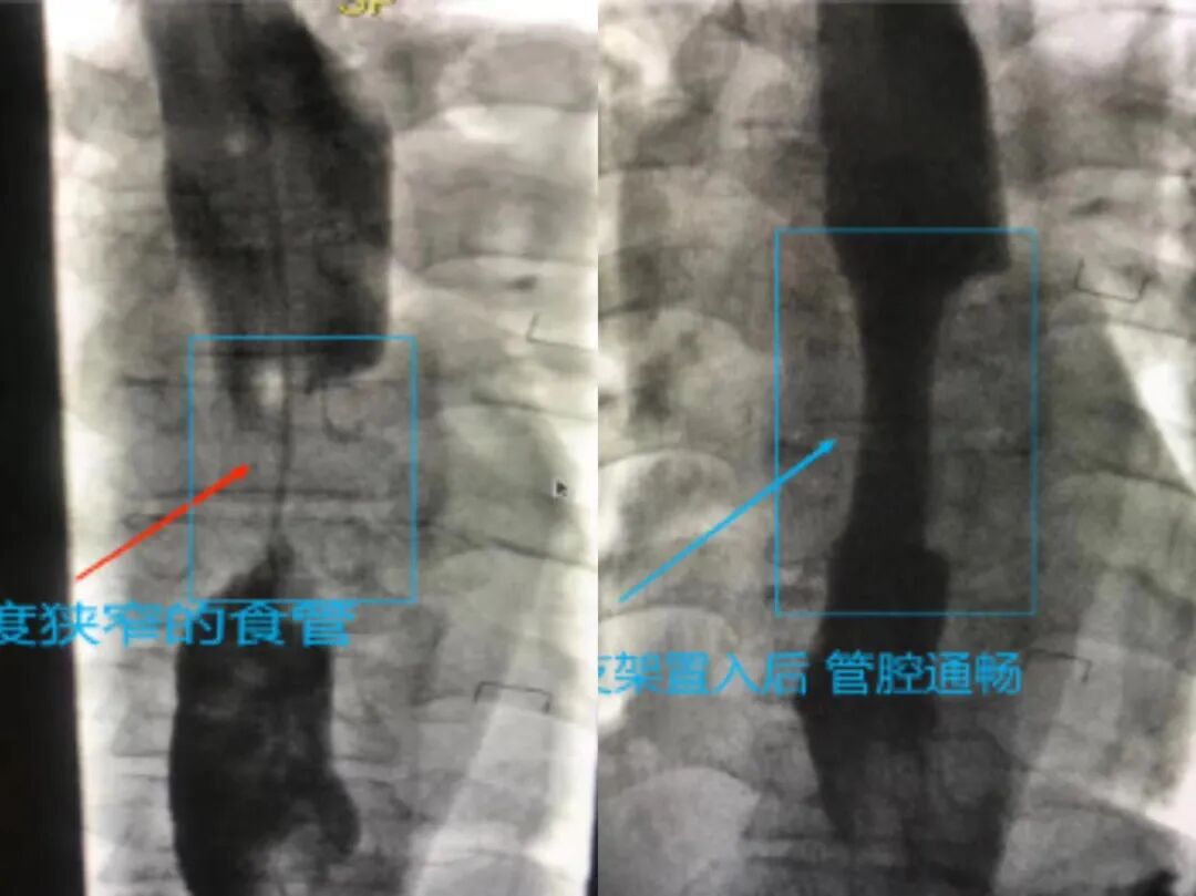 什么是外周介入【新技术】外周疾病找介入   微创高效多优处_https://www.jmylbn.com_新闻资讯_第4张